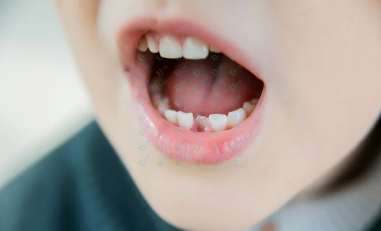 孩子好好的乳牙怎么越長越歪了呢？
