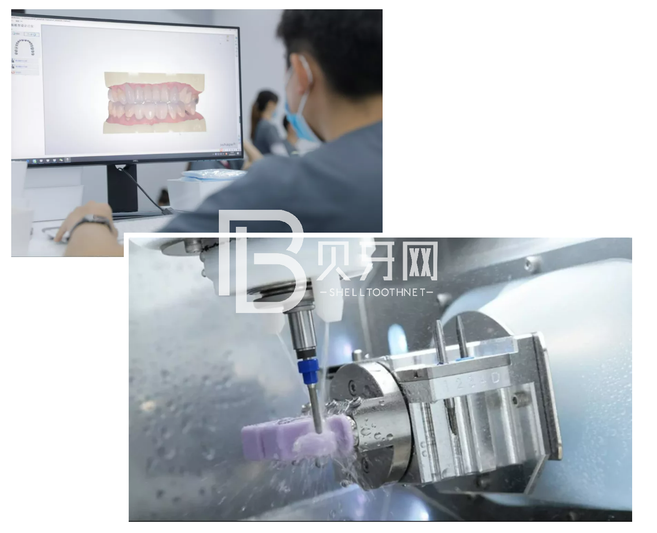 缺牙后最容易陷入的誤區(qū)，您中招了嗎？