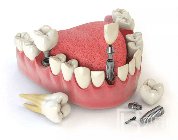 不到60歲，牙齒就所剩無幾了？這5件護(hù)牙小事，別等老了再做！