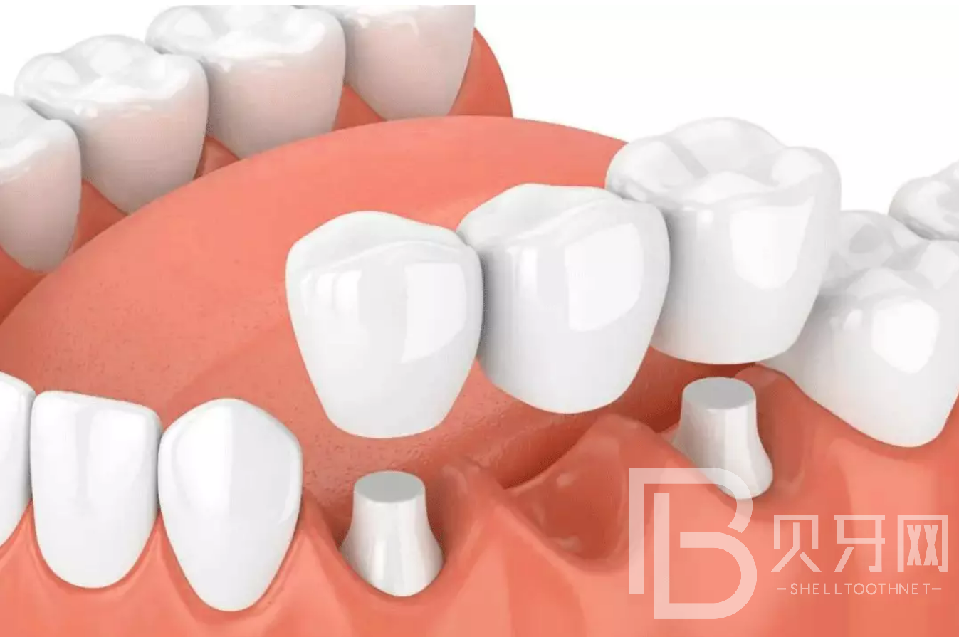 牙齒缺失會折壽10年？缺牙的后果比你想象的嚴重