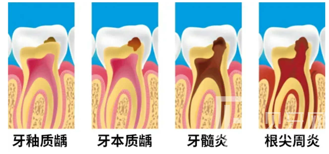 牙疼到無法入睡，我們該怎么辦？
