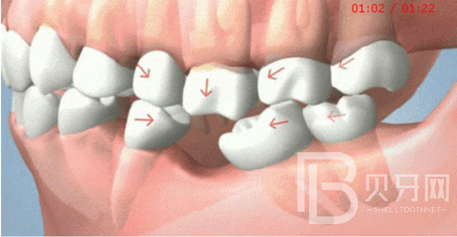 90%不知道，牙齒缺失后，盡然會出現(xiàn)這些癥狀！