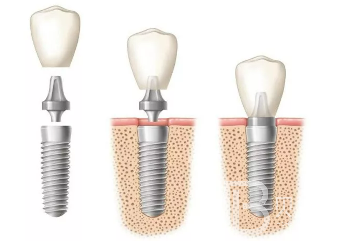 牙齒缺失做種植牙必須要植骨么？