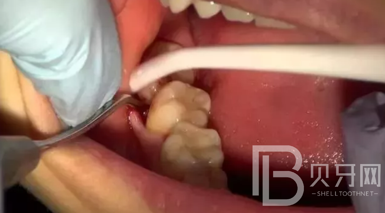 為什么牙醫(yī)建議讓拔掉智齒？