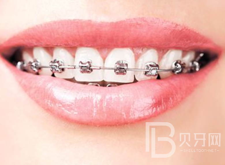 牙齒矯正有風(fēng)險(xiǎn)嗎？來聽聽口腔醫(yī)生怎么說