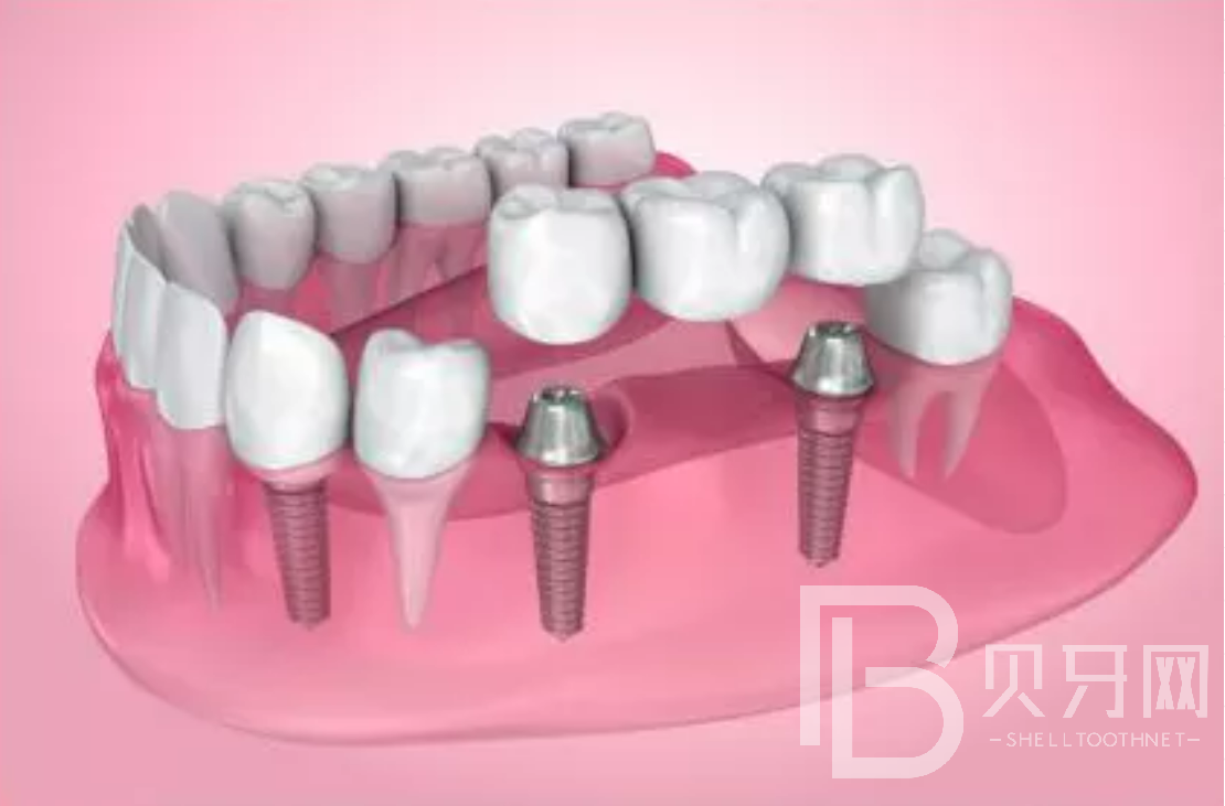 拔牙后一般多久能做種植牙？選什么植體比較好？