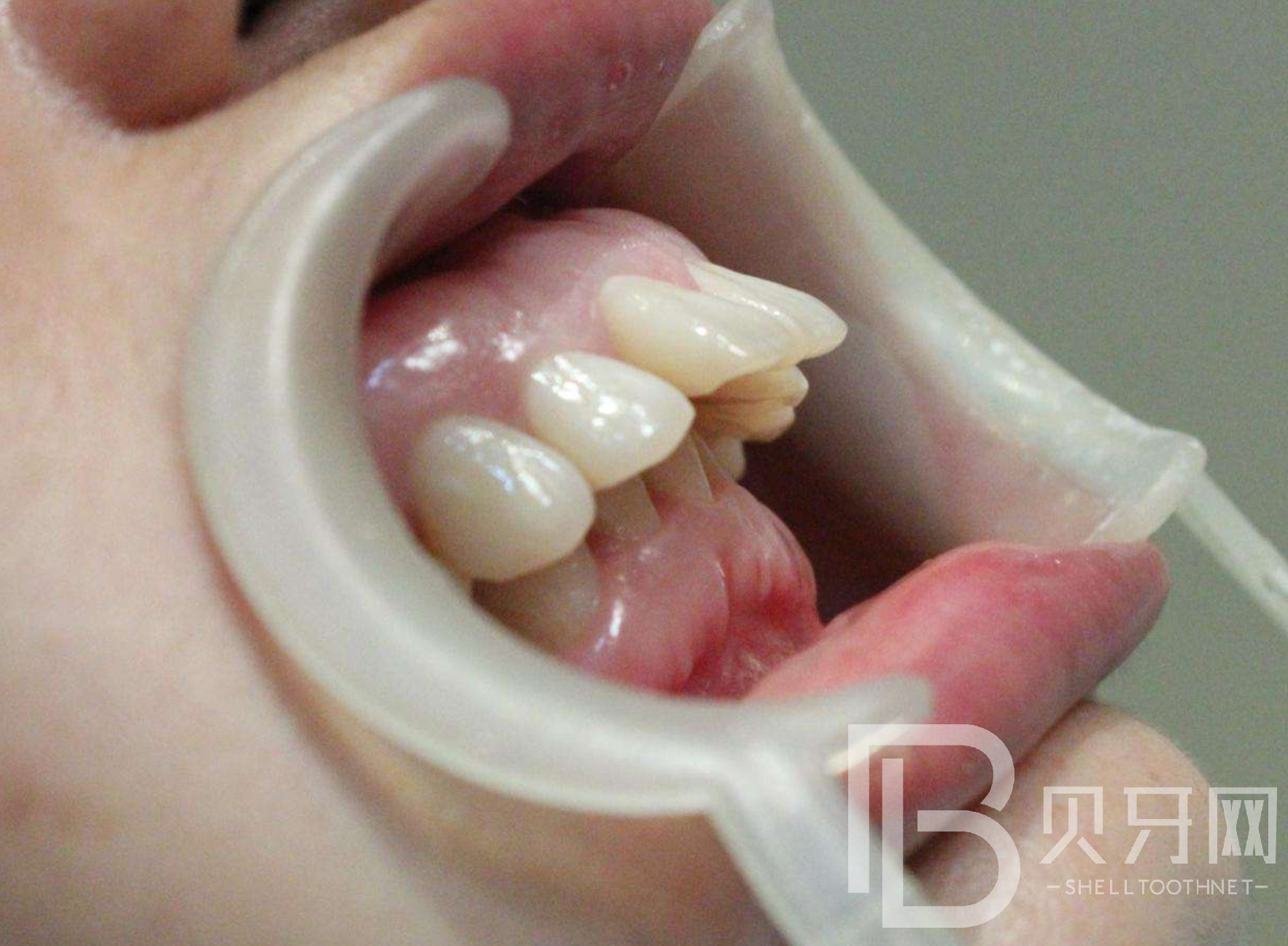 關于牙齒健康的4個秘密，你知道幾個？