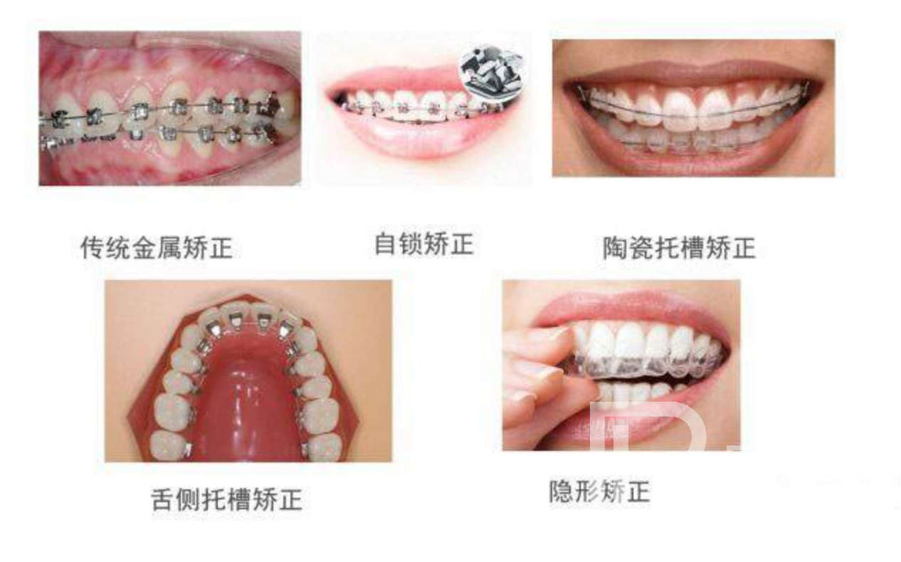 牙齒不整齊都有哪些矯正方式?分別價(jià)格多少錢？