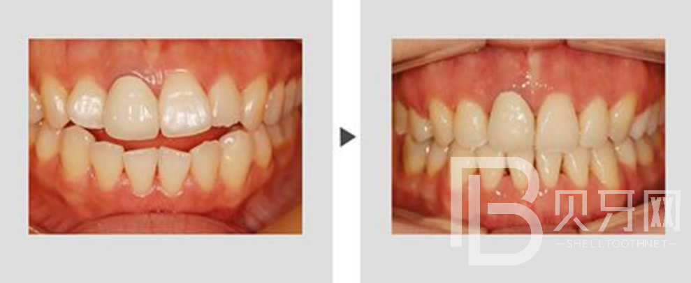 牙齒不齊一定要矯正嗎？還有哪些方式可以改變？