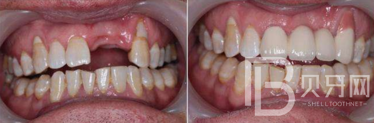 有牙周炎能不能做種植牙？