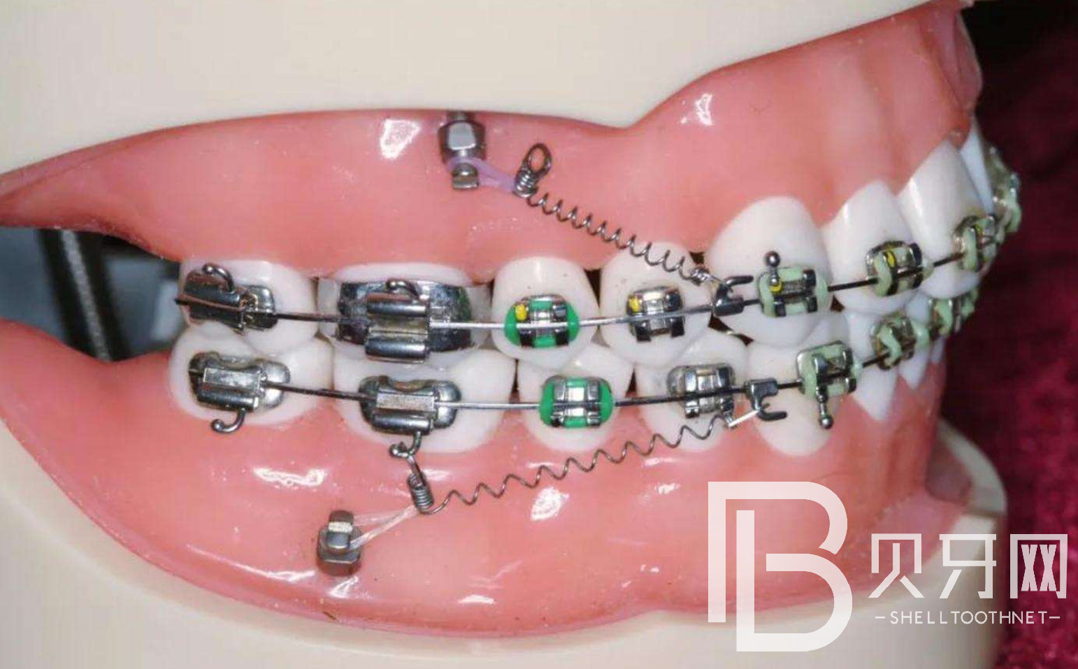 牙齒矯正多久才會有效果？牙齒矯正需要多長時間