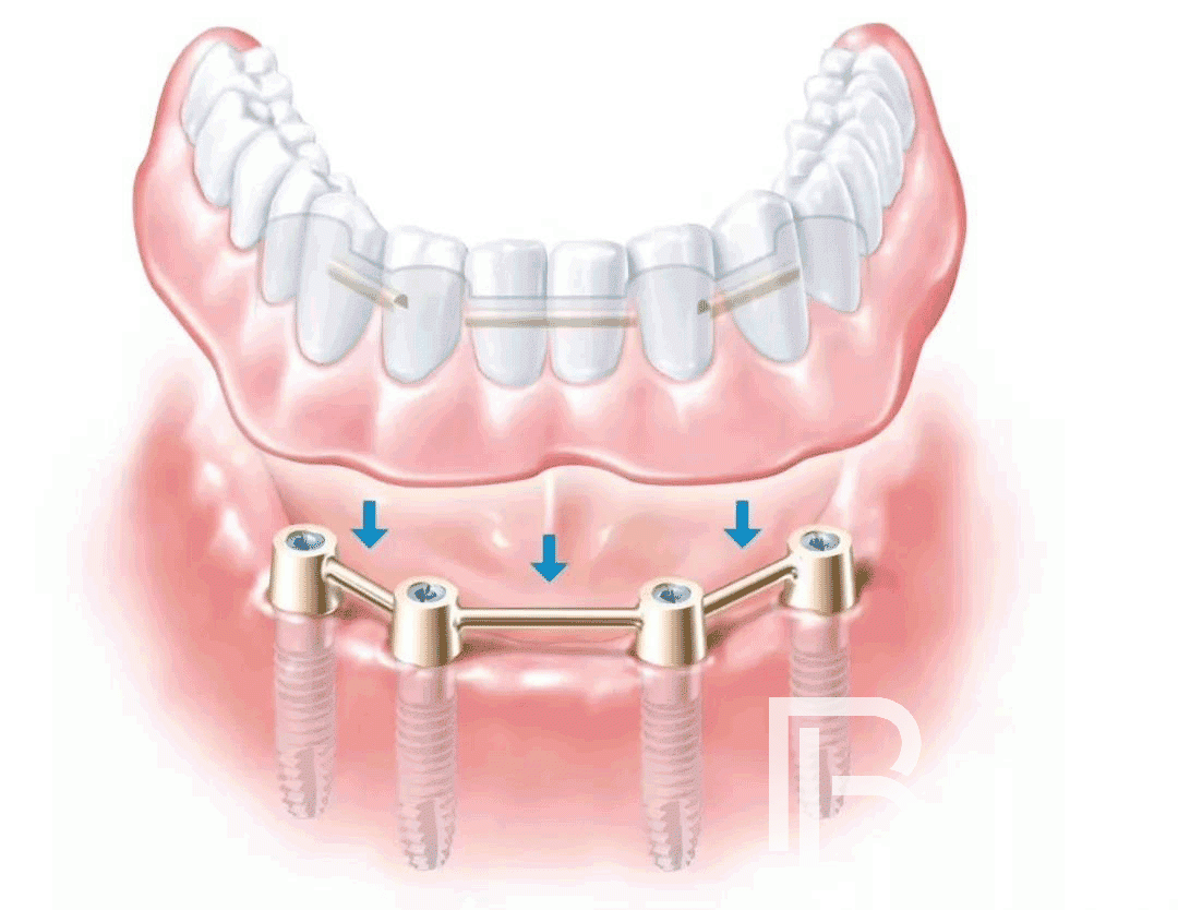 種植牙知識(shí)科普：All-on-4種植牙的幾個(gè)常見(jiàn)問(wèn)題！