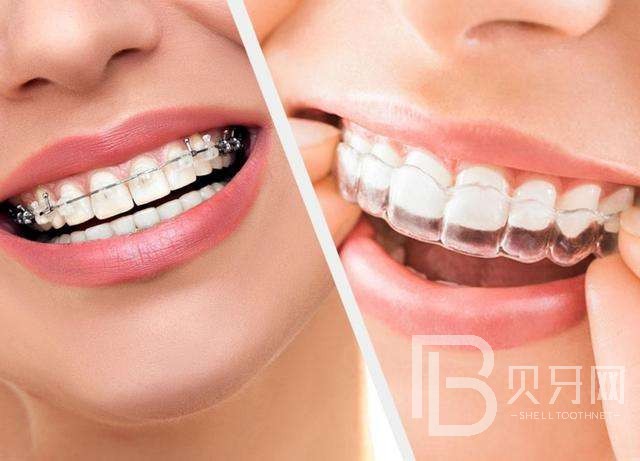 牙齒矯正有沒有年齡限制，牙齒矯正的黃金年齡
