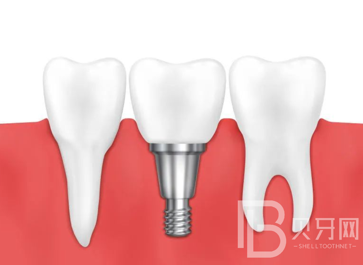 種植牙手術(shù)并發(fā)癥有哪些？