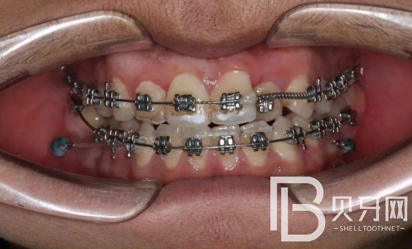 牙齒矯正之前，這幾件事一定要知道