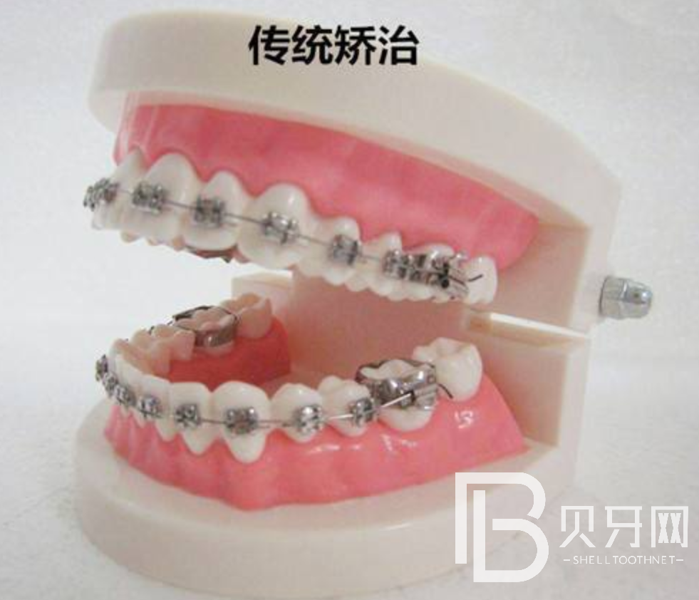 牙齒矯正需要多久，流程是什么樣的？