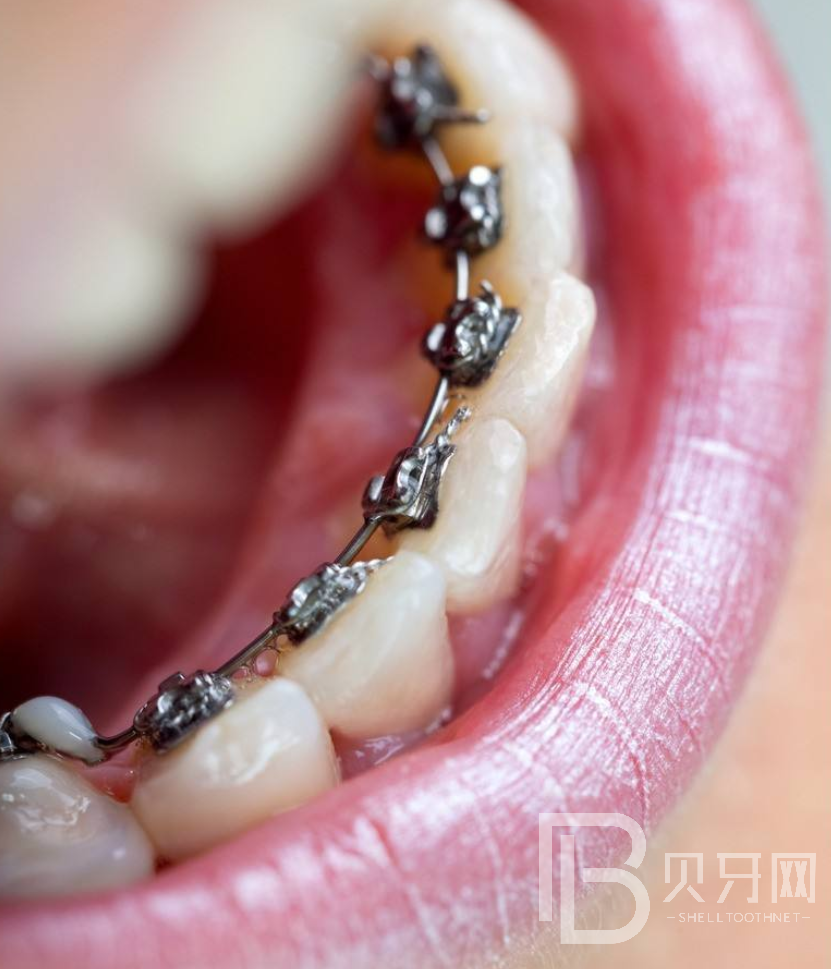 牙齒矯正后要注意什么？聽聽牙醫(yī)怎么說