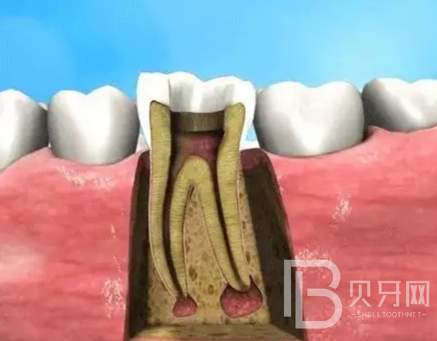 補(bǔ)牙和根管治療有什么區(qū)別？