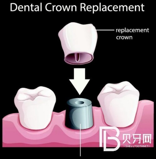 為上海牙齒缺失的市民提供一份全新的全口種植牙價(jià)格表