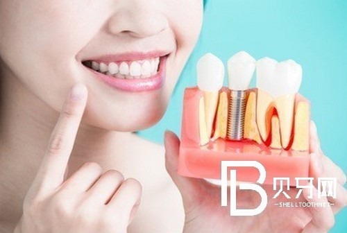 上海雅悅口腔種植牙怎么樣？上海雅悅種植牙怎么收費(fèi)？