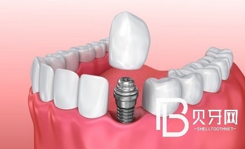 北京做烤瓷牙好的醫(yī)院，烤瓷牙和全瓷牙有什么區(qū)別？