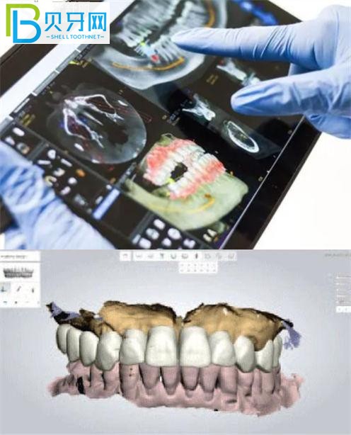 美奧口腔種植牙技術(shù)怎么樣 徐州的單顆半口都多少錢？
