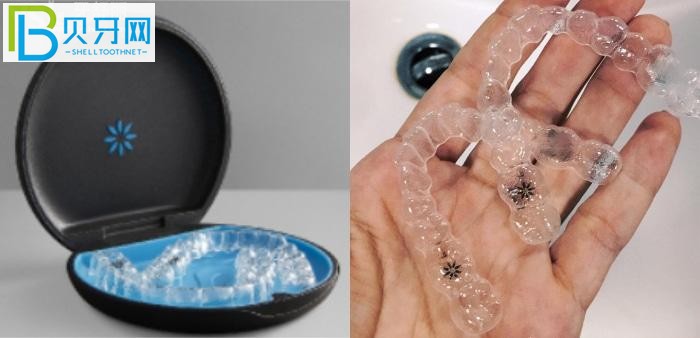 珠海隱形牙套哪家醫(yī)院比較好?推薦暨博口腔技術(shù)好價(jià)不高!