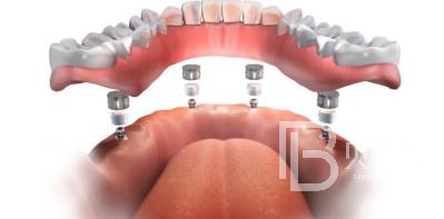 全口種植牙需要種幾棵？北京維樂口腔種植牙技術(shù)怎么樣？