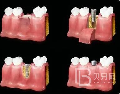 廣州圣貝口腔口碑好不好？靠譜嗎？70歲的老年人可否種植牙