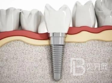 廣州德倫口腔種植牙多少錢？廣州德倫口腔矯正多少錢 ？廣州德倫口腔價(jià)格一覽表！