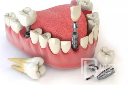 廣州拜博口腔口碑好不好？靠譜嗎？廣州拜博口腔種植牙多少錢