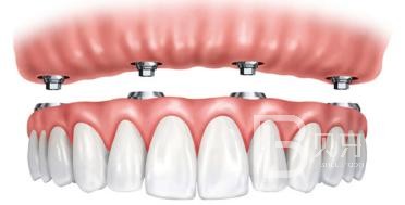 即刻種植牙好還是3月后種植好？北京德貝口腔種植牙怎么樣？