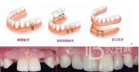 60歲的人種植牙還是鑲牙好？北京冠美口腔怎么樣？