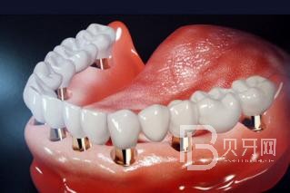 半口種植牙要種幾顆？北京維樂口腔正規(guī)嗎？