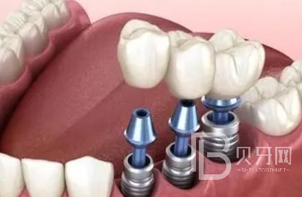 廣州諾爾口腔怎么樣？廣州諾爾口腔種植牙一顆多少錢