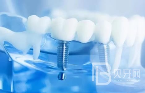 廣州友睦口腔怎么樣？廣州友睦口腔口碑好不好？廣州友睦口腔種植牙價(jià)格