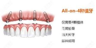 全口種植牙需要種植幾顆？北京永康口腔怎么樣？