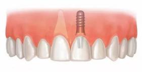 老年人適合的種植牙？北京諾美口腔怎么樣？