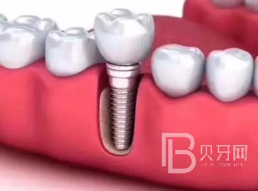 廣州研科口腔醫(yī)院怎么樣？廣州研科口腔口碑好不好？廣州研科口腔種植牙多少錢