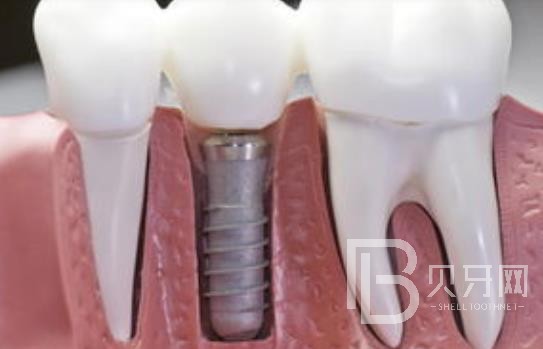 廣州柏德口腔怎么樣？廣州柏德口腔種植牙一顆多少錢