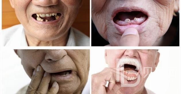 深圳韋博口腔80歲種植牙