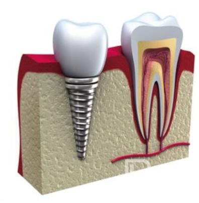 廣州德祥口腔怎么樣？廣州德祥口腔口碑好不好？廣州德祥口腔種植牙價格
