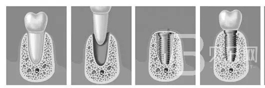 深圳瑞爾口腔半口種植牙即刻負重