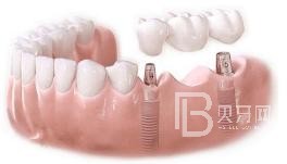 75歲老人適不適合做種植牙？北京圣貝口腔怎么樣？