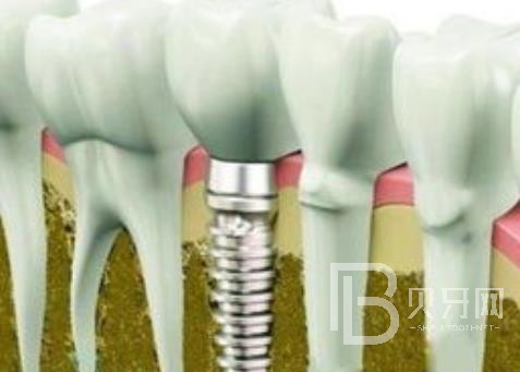 廣州固美口腔怎么樣？廣州固美口腔種植牙一顆多少錢