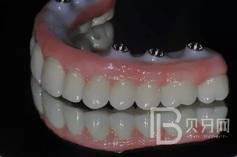 全口種植牙的利與弊都有哪些？北京拜博口腔正規(guī)嗎？