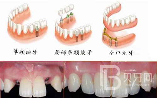半口種植牙一般需要幾個(gè)階段？北京德貝口腔種植牙正規(guī)嗎？