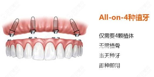 滿口種植牙需要種幾顆？北京佳美口腔正規(guī)嗎？