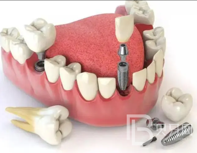 深圳銘德口腔全口牙缺失種植牙