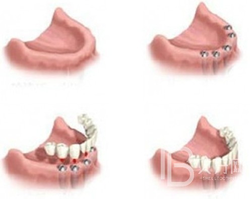 即拔即種植牙的條件？北京壹加壹口腔怎么樣？